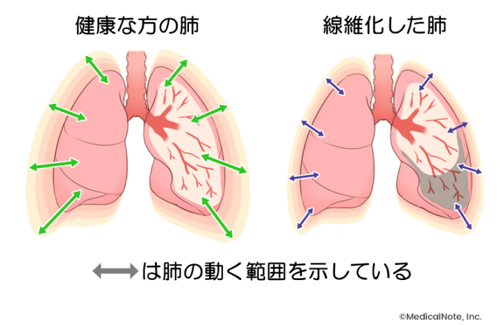 嚢胞性線維症ベストの価格はいくらですか?