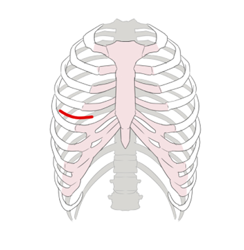 低侵襲心臓手術（MICS）の切開位置を示すイラスト。右胸の下側を数センチ切開する。