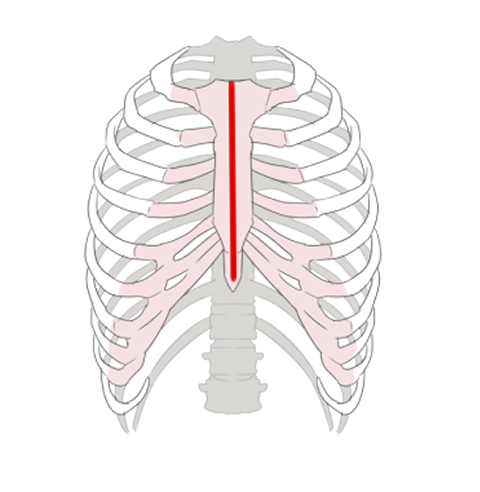 従来の手術（胸骨正中切開）の切開位置を示すイラスト。胸の中央を大きく縦に切開する。