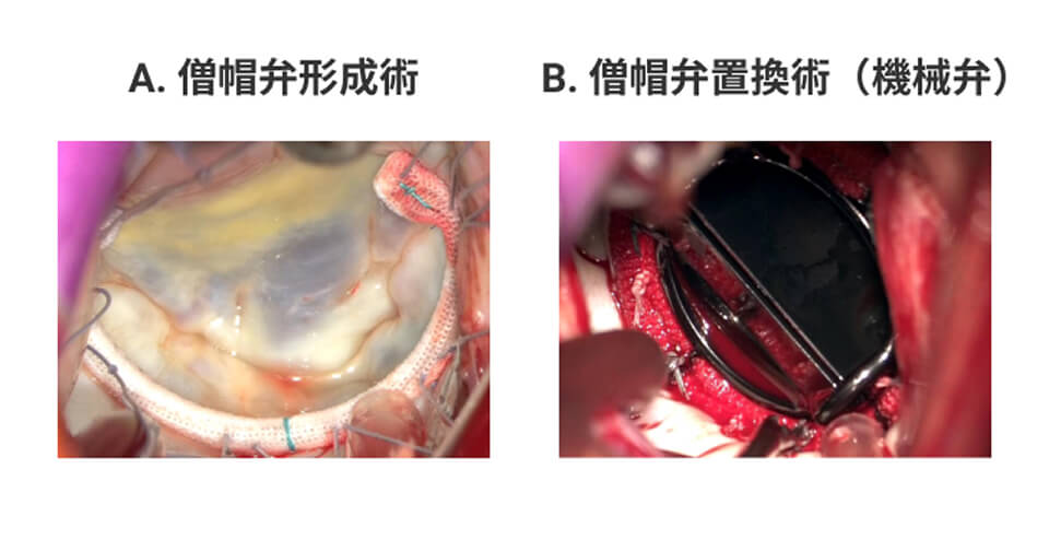 手術中の心臓の比較写真。左は僧帽弁形成術の写真、右は僧帽弁置換術の写真。