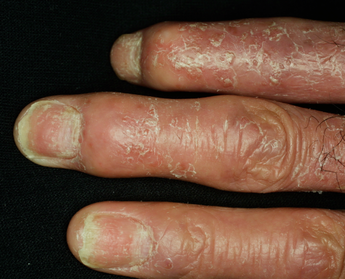 乾癬患者の今後の見通しはどうなるのでしょうか?