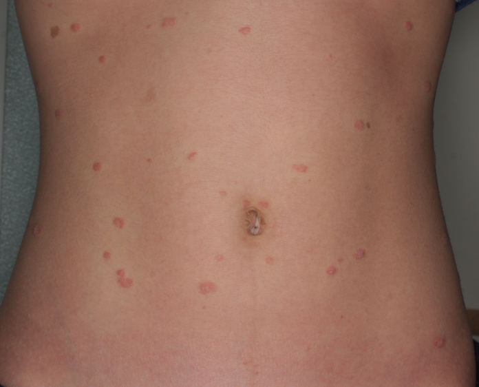 舌の乾癬のリスクがあるのは誰ですか?