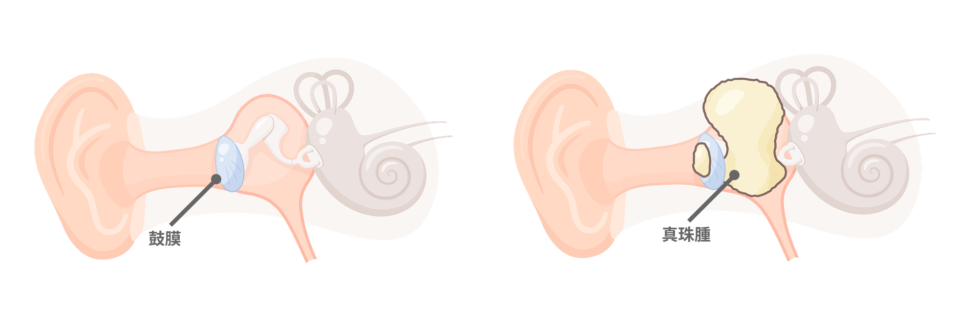 健やかな聴力を長く維持するために――聞こえにくさや耳だれは一度受診を