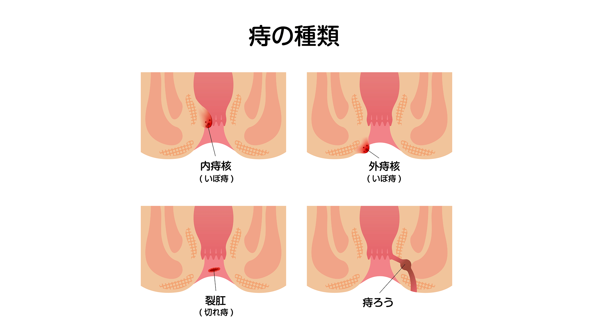 早期治療により手術せずに治ることも――慢性化する前に早めの受診を