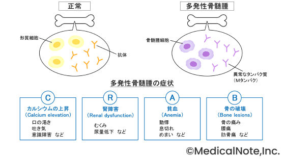 症状があっても必ずしも手遅れではない――治療は“CRAB症状が現れてから”