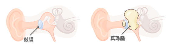 健やかな聴力を長く維持するために――聞こえにくさや耳だれは一度受診を