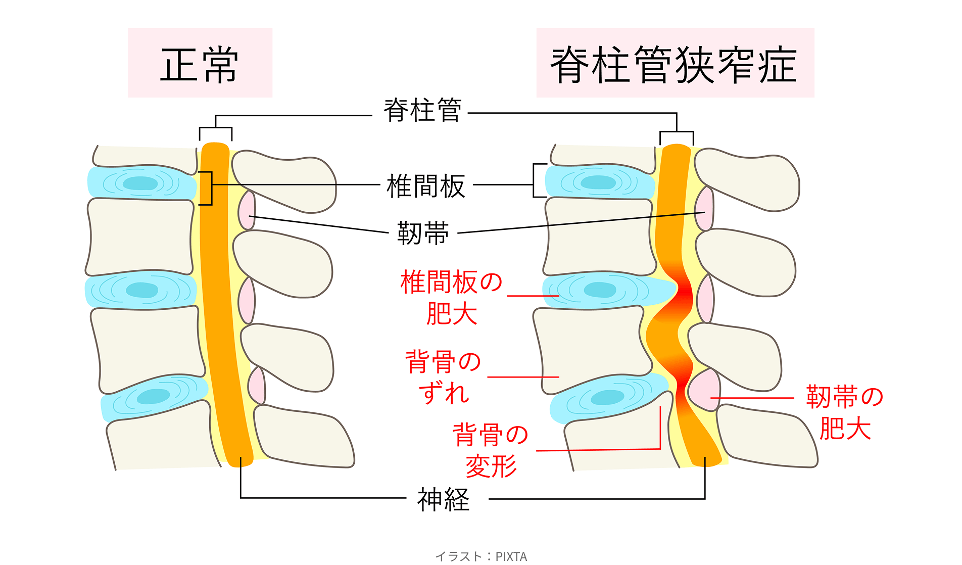 歩行時のしびれや痛み、歩き続けられない症状は整形外科の受診を