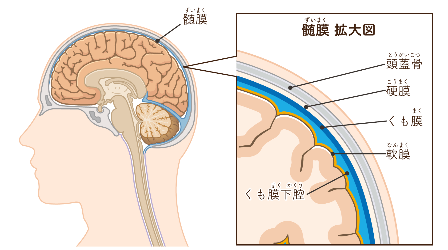 脳を包む膜から発生する髄膜腫――多くは良性であるものの神経症状には要注意