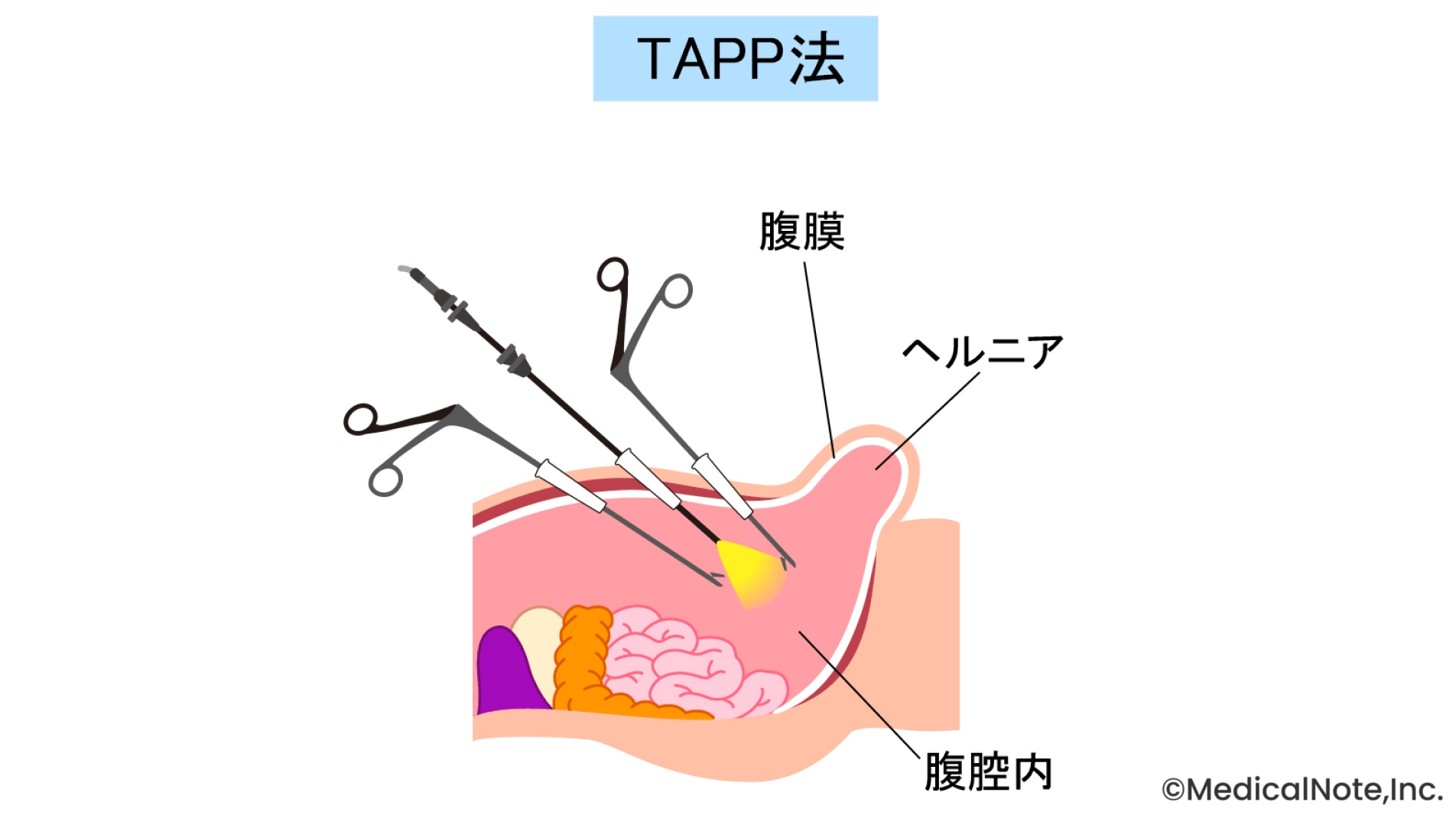 安全性と低侵襲の両立を目指した腹腔鏡下手術を実施