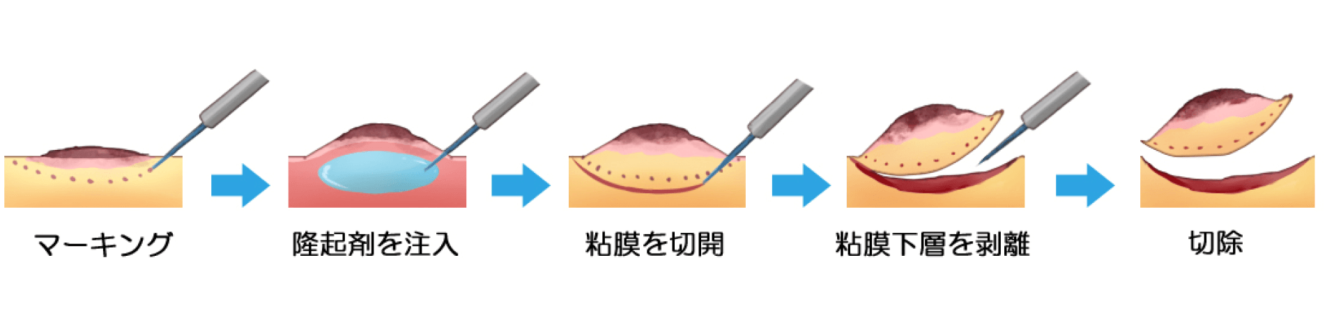 患者さんの負担が圧倒的に少ない“内視鏡的粘膜下層剥離術（ESD）”