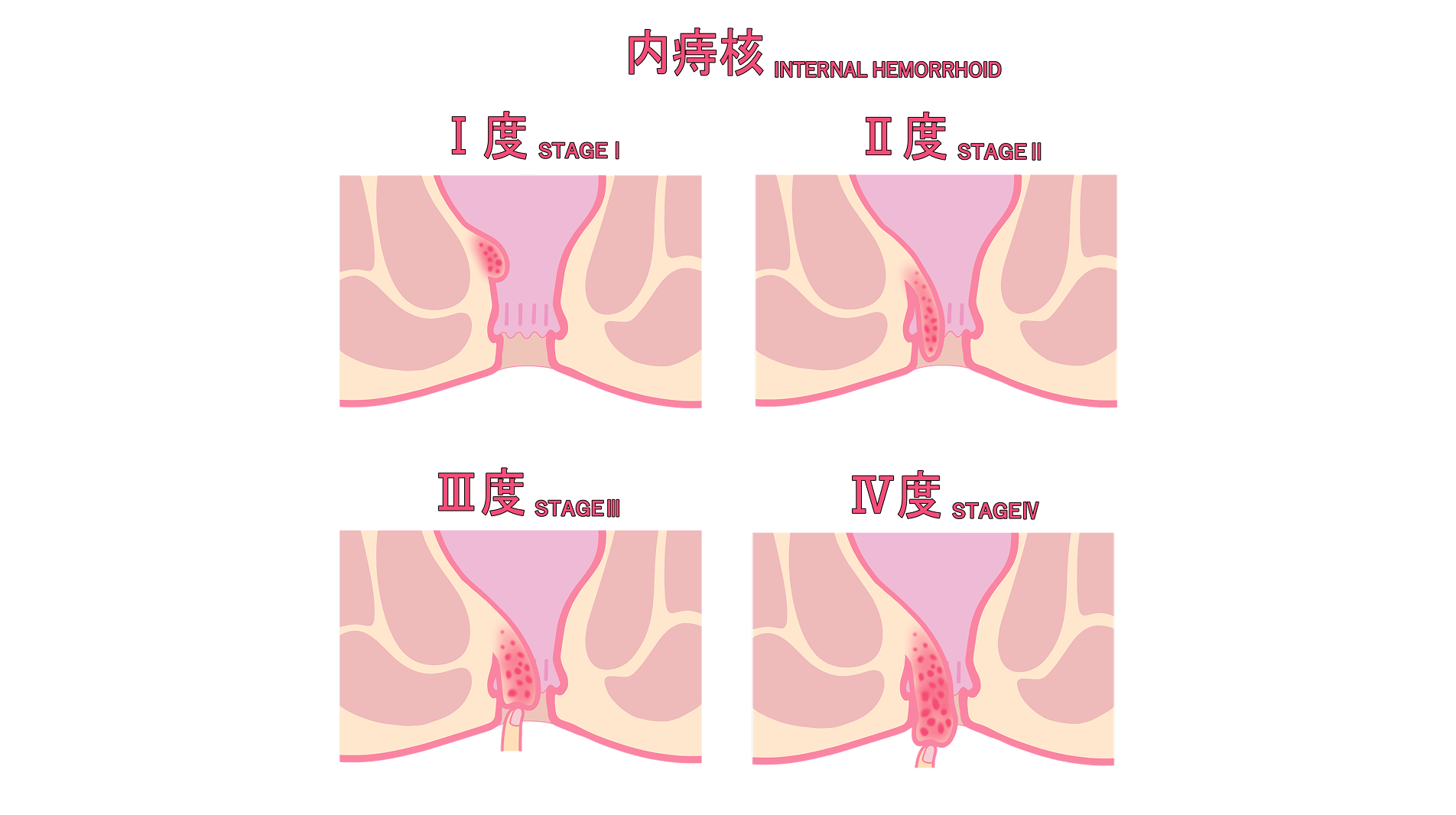 放っておくと悪化することも――お尻の違和感は早めに受診を
