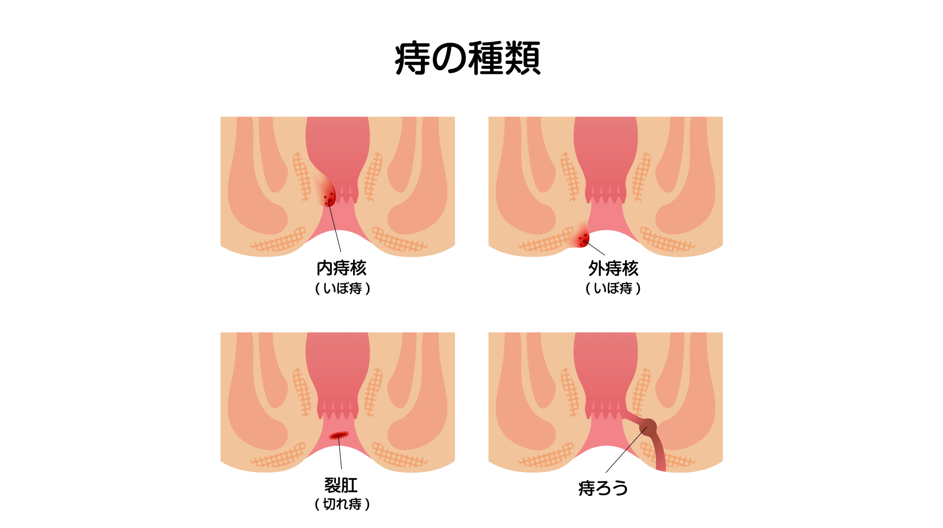 幅広い世代の方がなる病気――肛門の症状は専門医*の受診を