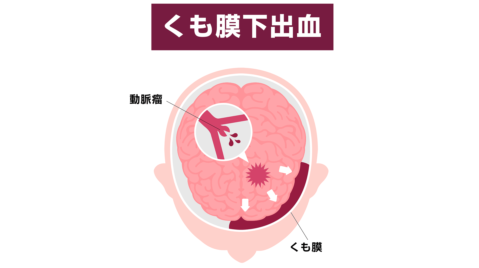 くも膜下出血を起こすリスクがある病気――脳動脈瘤の特徴から破裂リスクを見極める