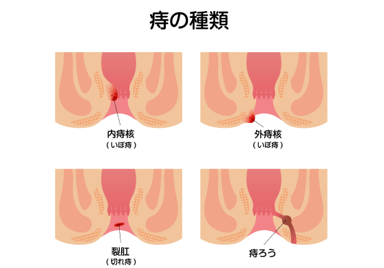 幅広い世代の方がなる病気――肛門の症状は専門医*の受診を