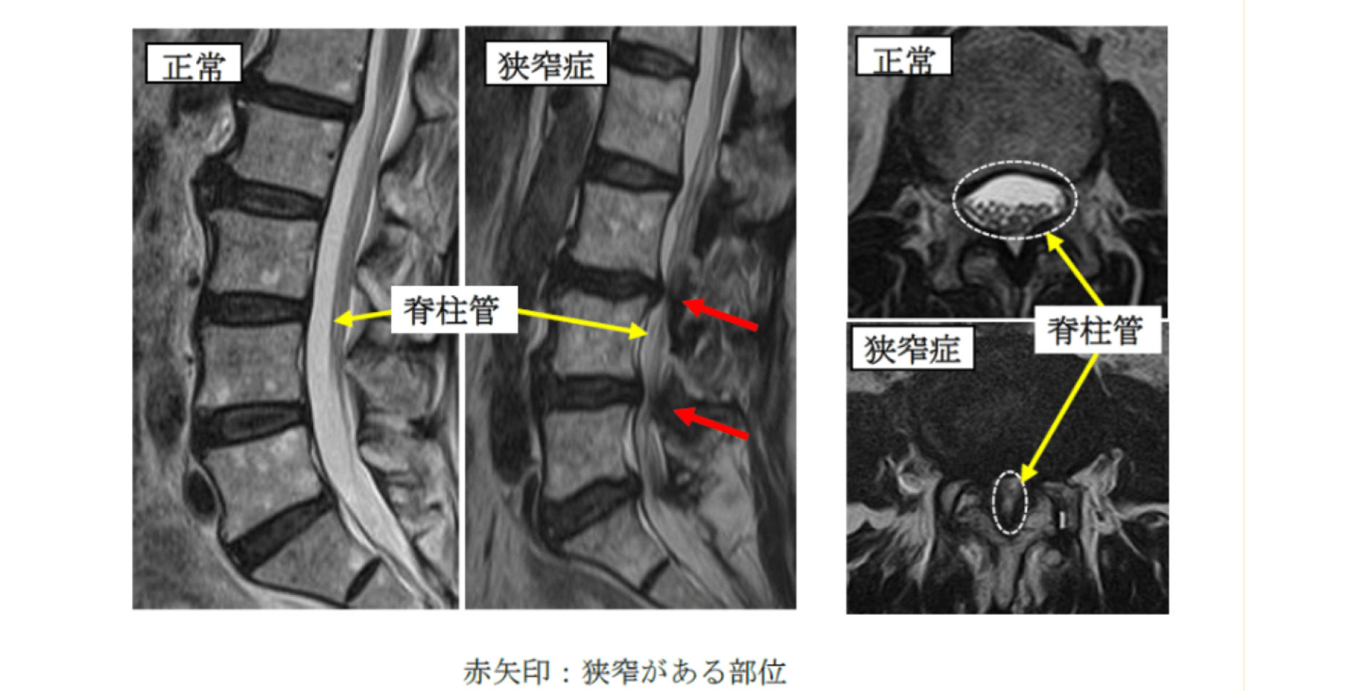 腰部脊柱管狭窄症の治療