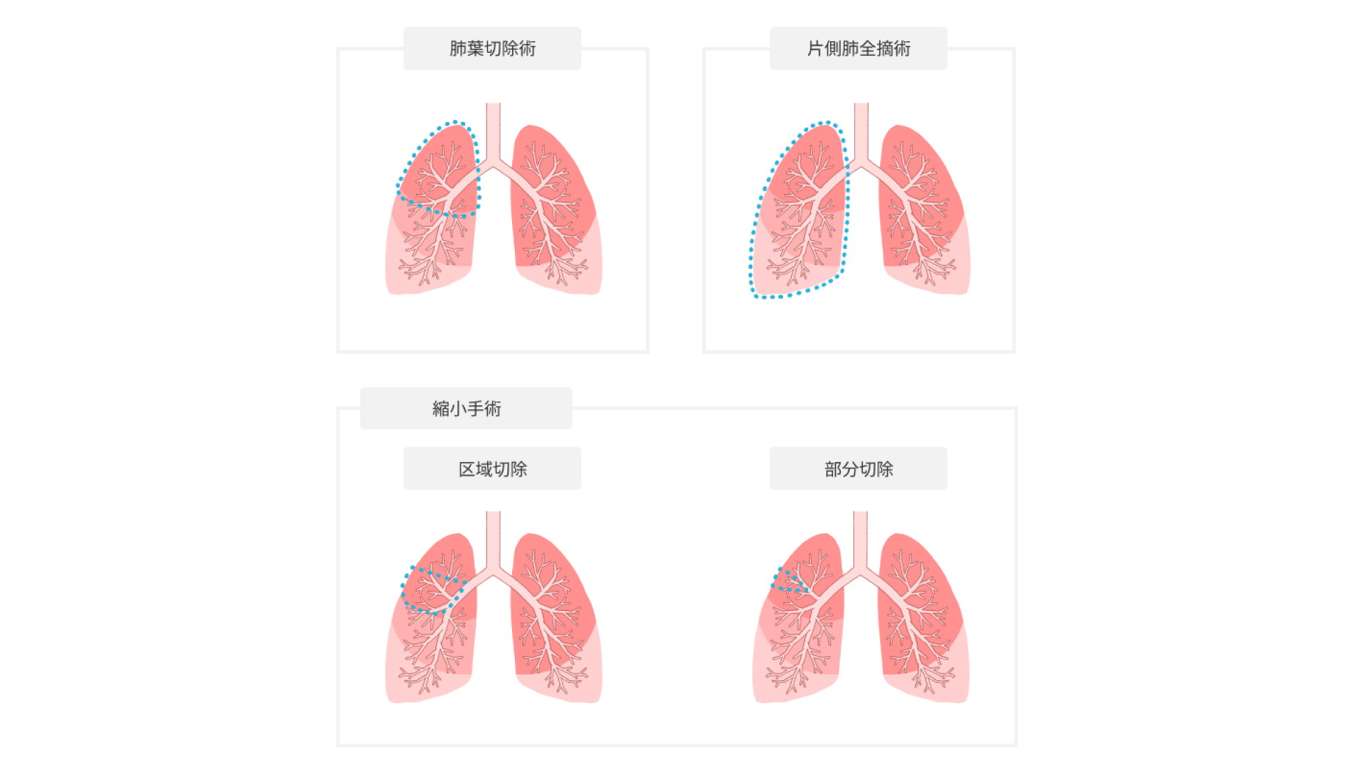 体の負担が少ない胸腔鏡下手術、縮小手術に対応