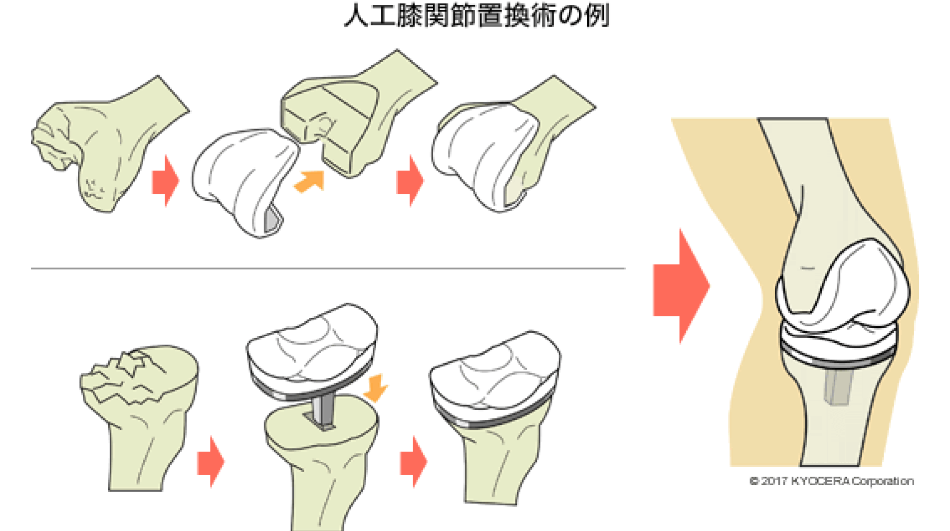 手術のタイミングが重要――高齢を理由に諦めずにぜひ相談を