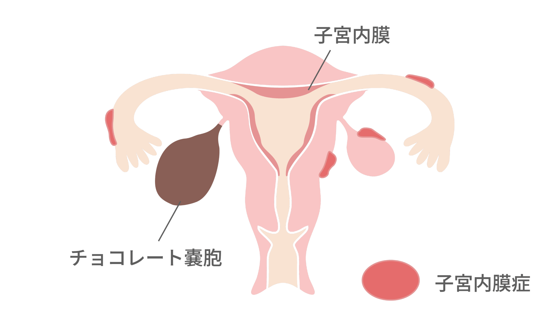 子宮内膜症の治療：患者さんのライフステージや希望に沿った治療を提供