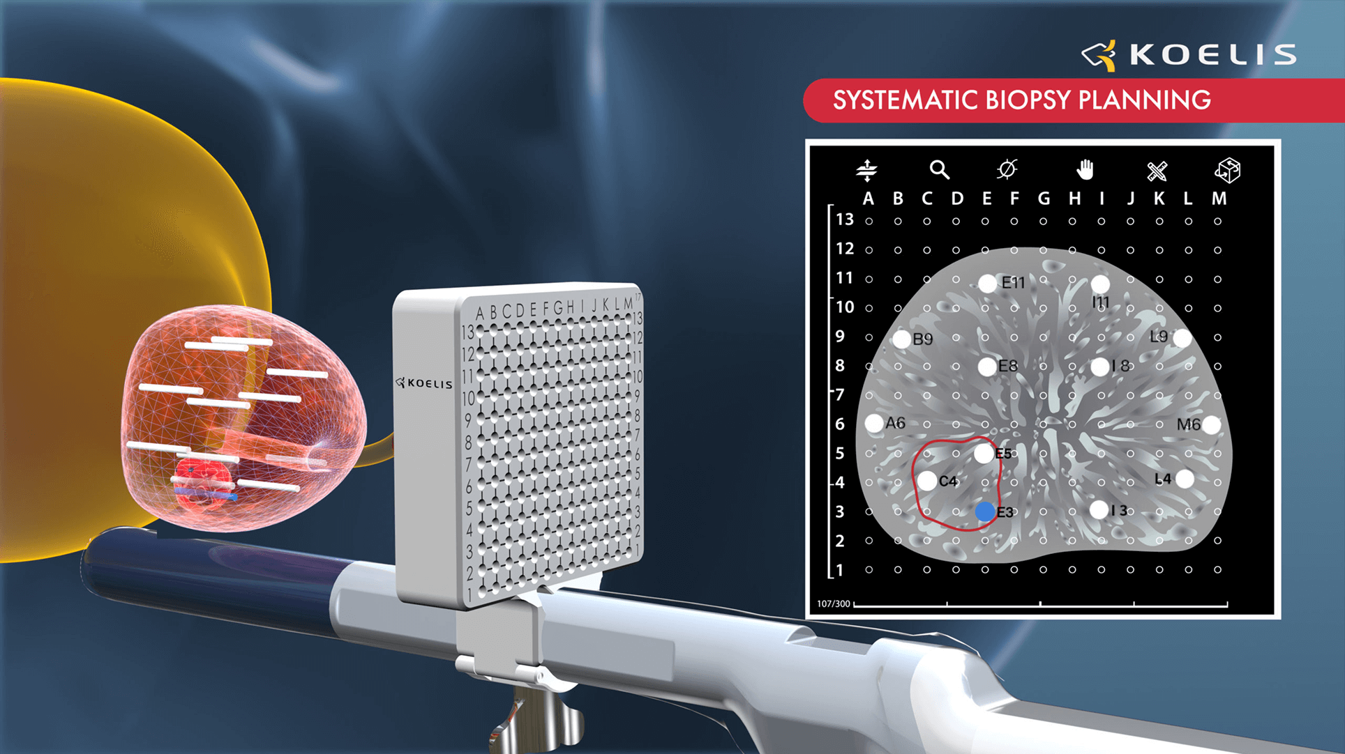 新技術を使った病変を正確に狙う前立腺針生検