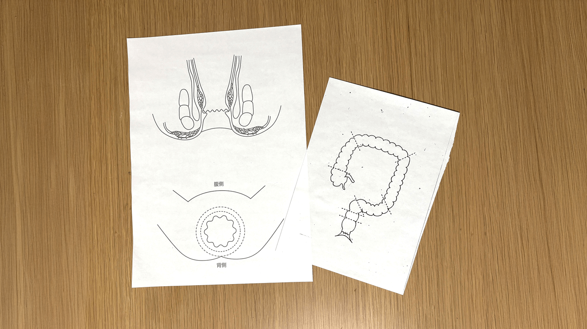 痛みに配慮した痔核治療――経験に基づき適切な治療を提供
