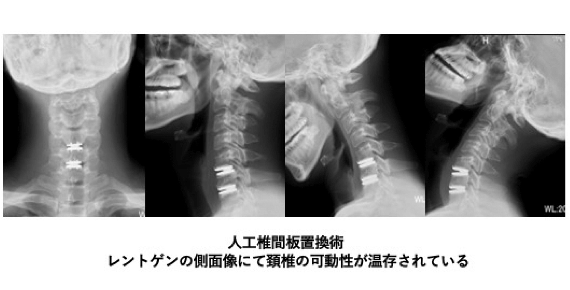 頚椎症・頚椎椎間板ヘルニアの治療