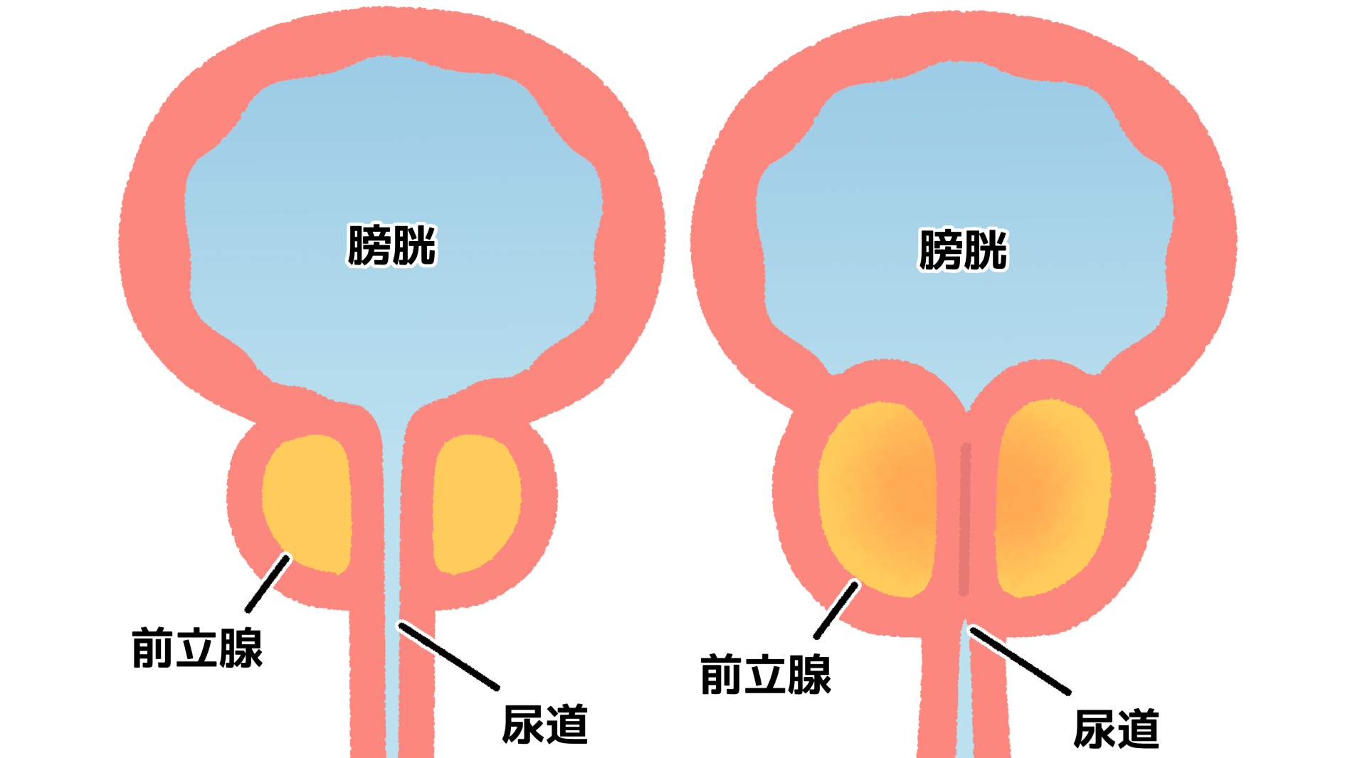 前立腺肥大症の治療:前立腺を切らない“ウロリフト”を導入