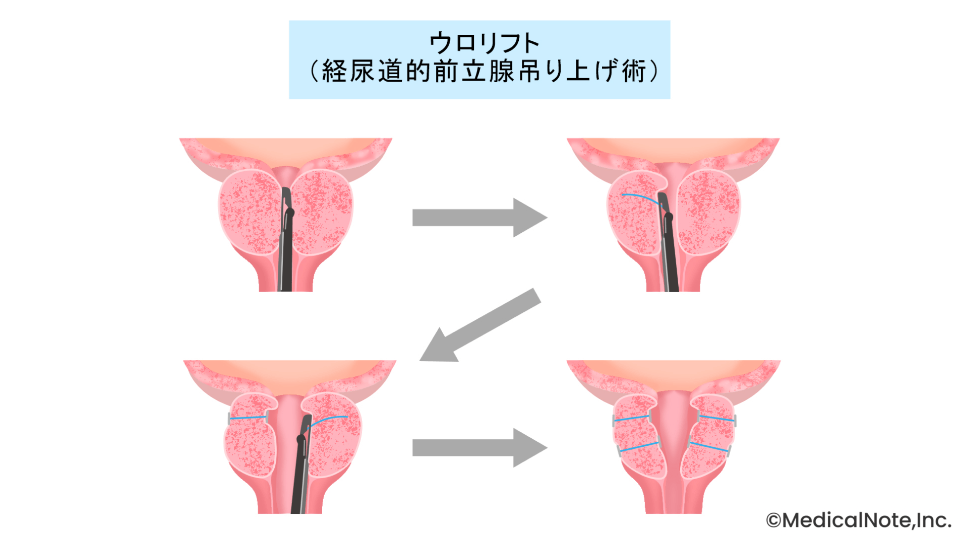 前立腺肥大症の治療:前立腺を切らない“ウロリフト”を導入