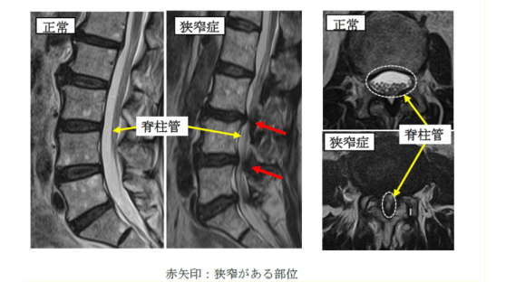 腰部脊柱管狭窄症の治療