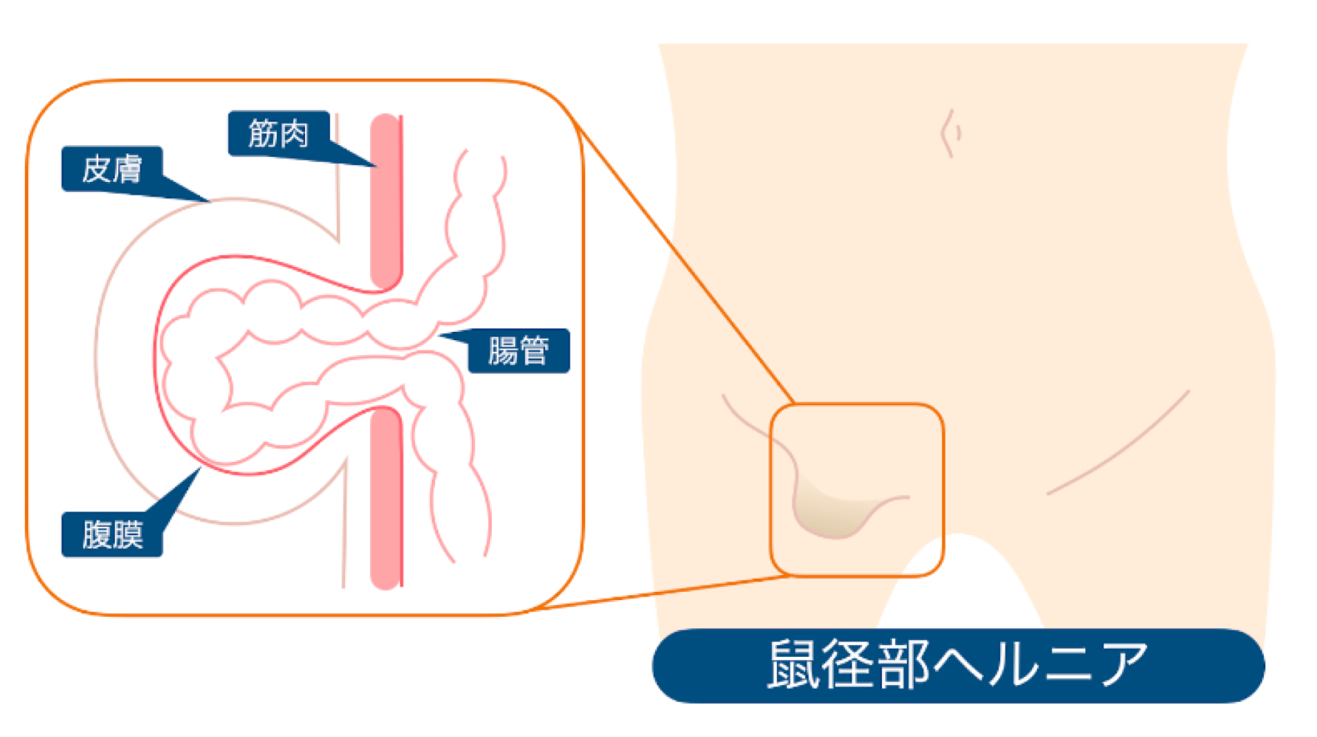 自然治癒は望めない鼠径ヘルニア