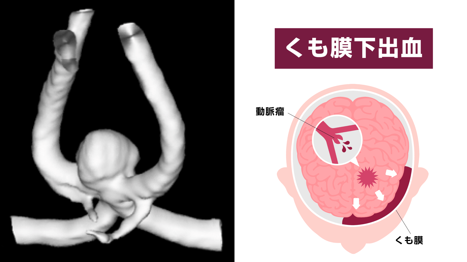 「自分は大丈夫」「このくらいで」と思わず、積極的に脳の検査を