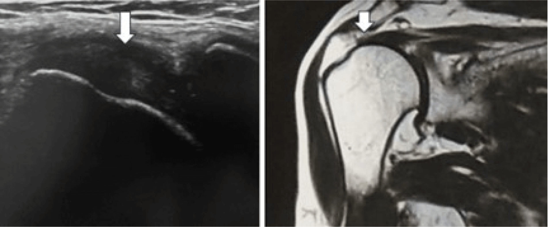 五十肩と間違われやすい“肩腱板断裂”――肩の痛みを感じたら受診を