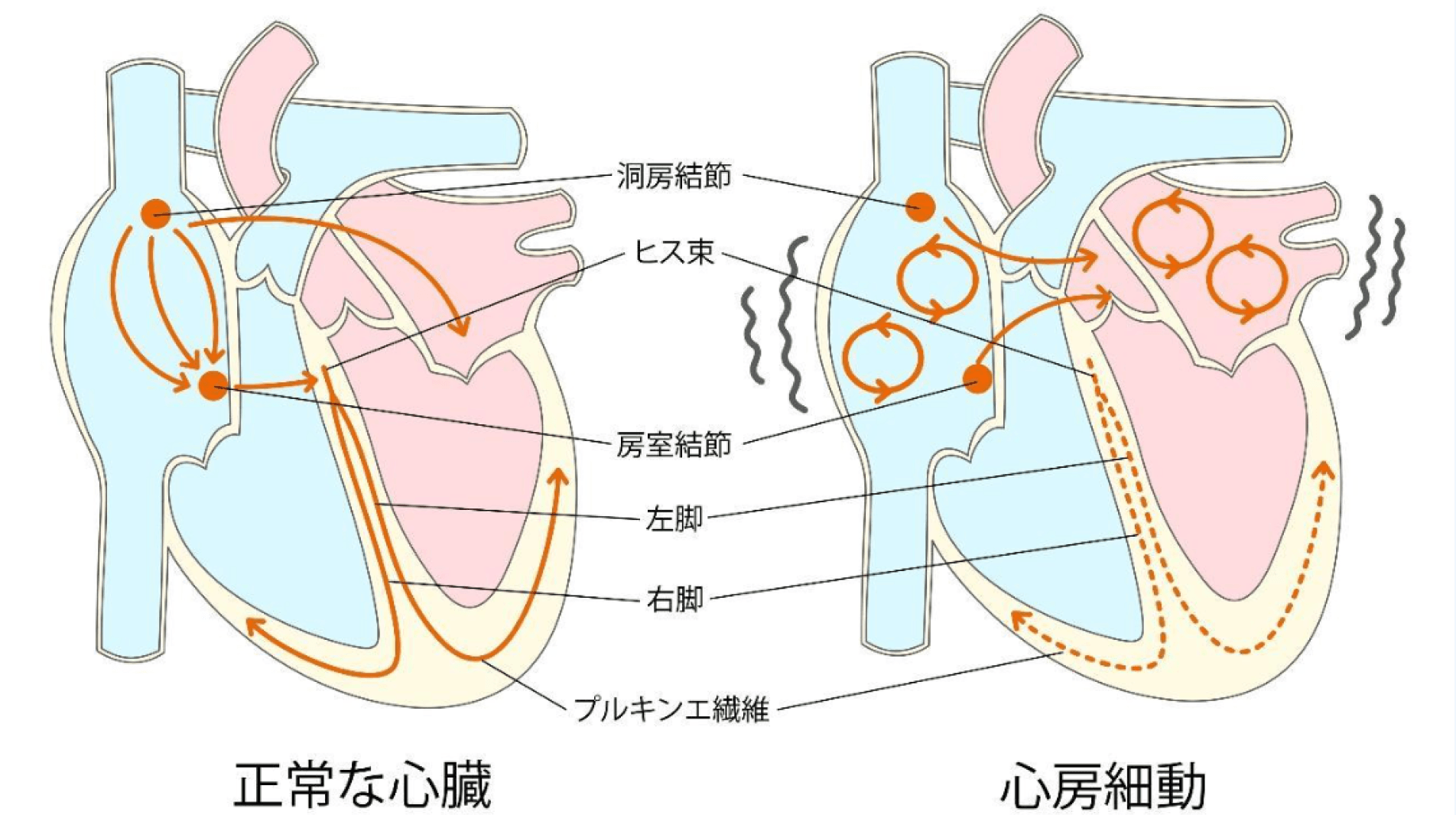 脳梗塞や心不全の原因となる心房細動――脈の乱れを感じたら一度受診を