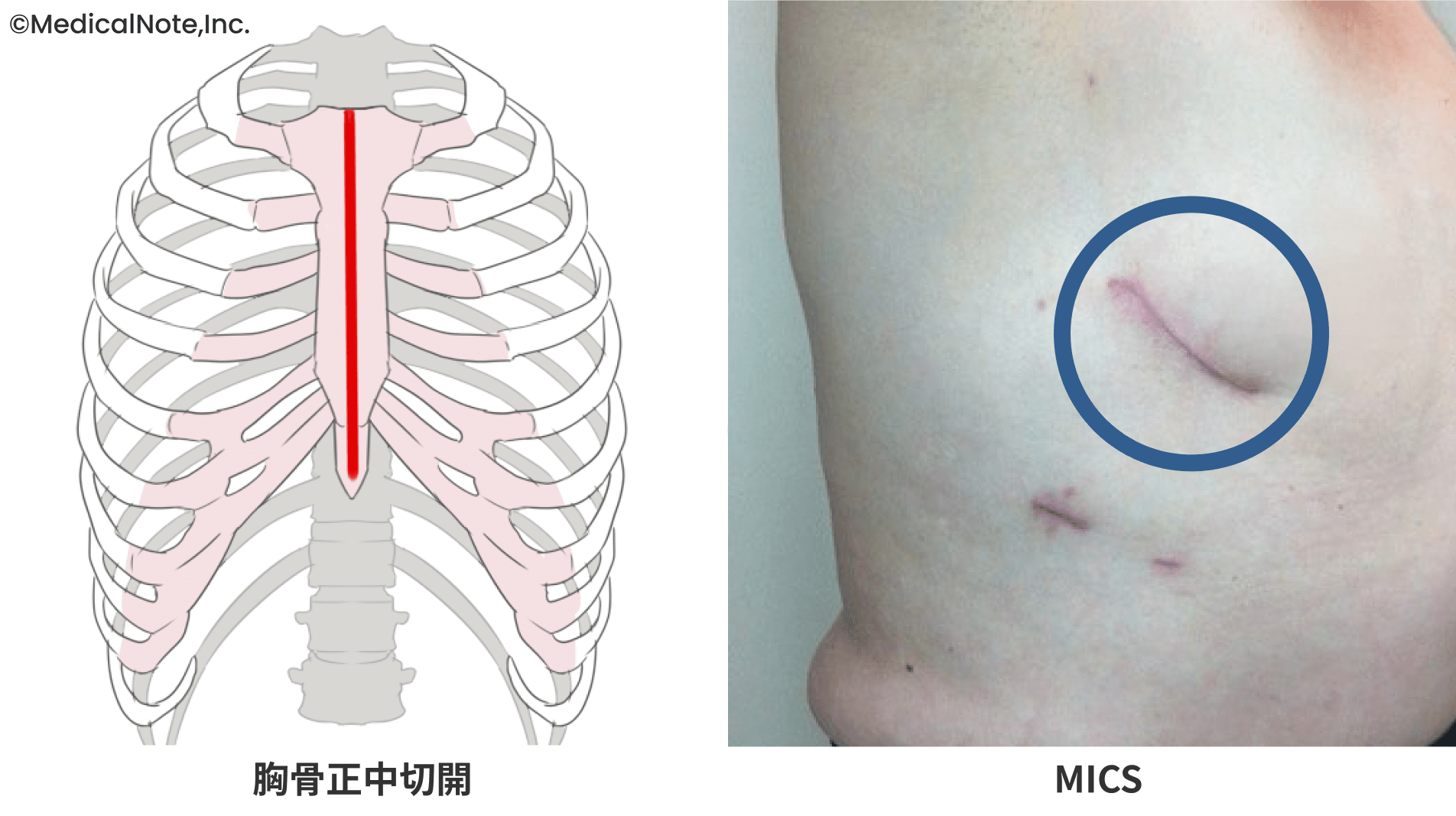 患者さんの体への負担を減らした治療を提供すべく、TAVIとMICSを実践_画像2