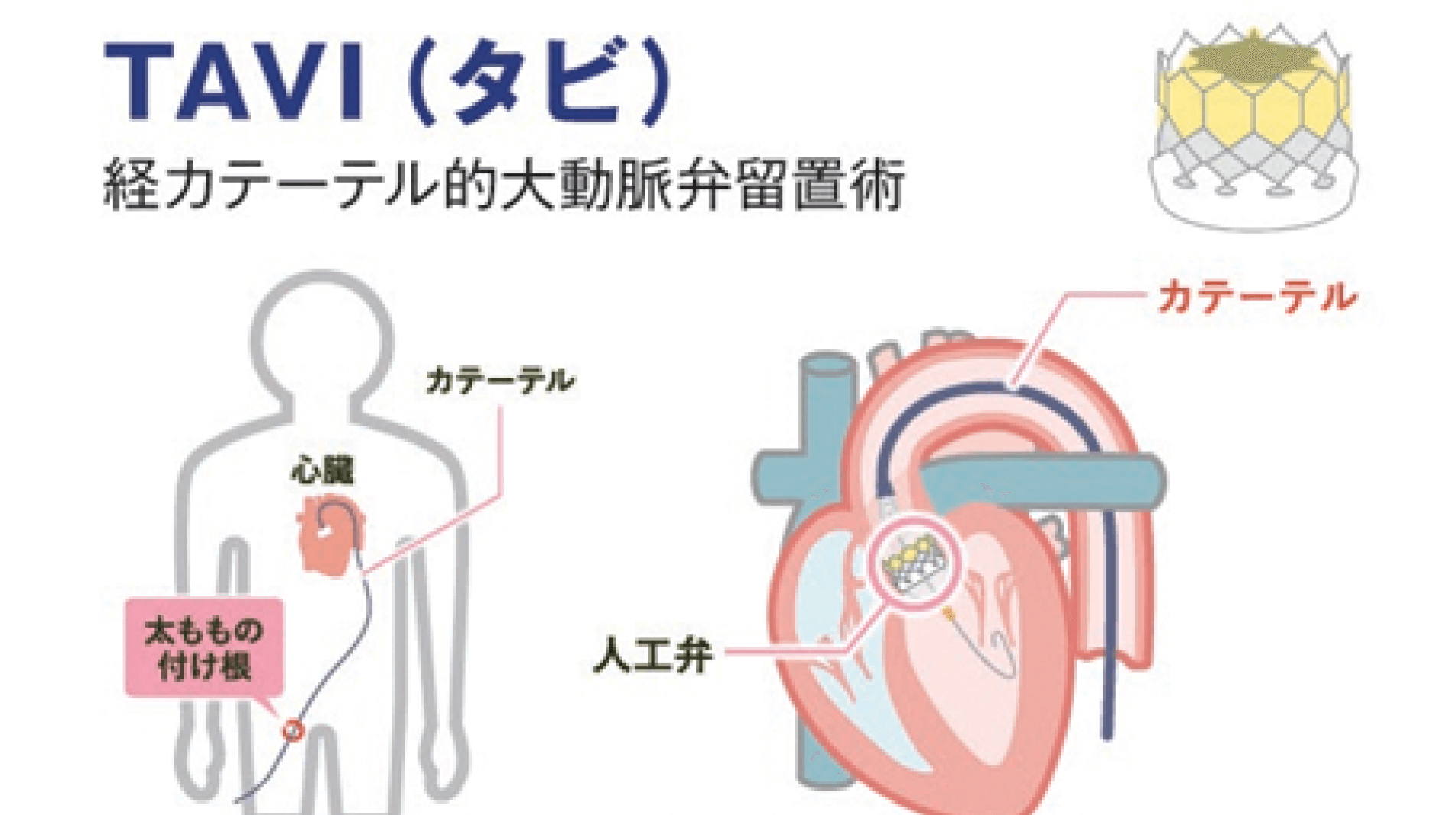 内視鏡下MICSやカテーテル治療などを導入し、高い根治性と負担軽減の両者を追求する