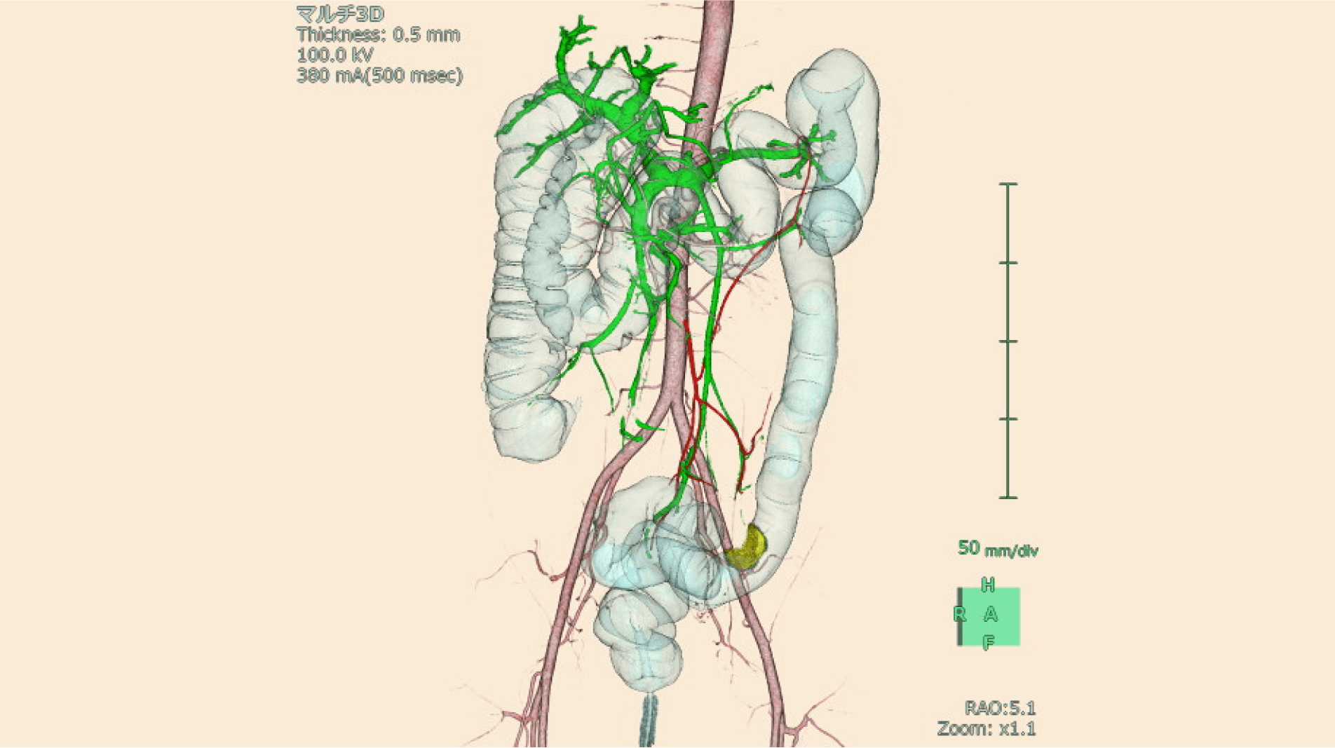 入念な術前検査とロボット支援下手術で精度の高い手術を目指す