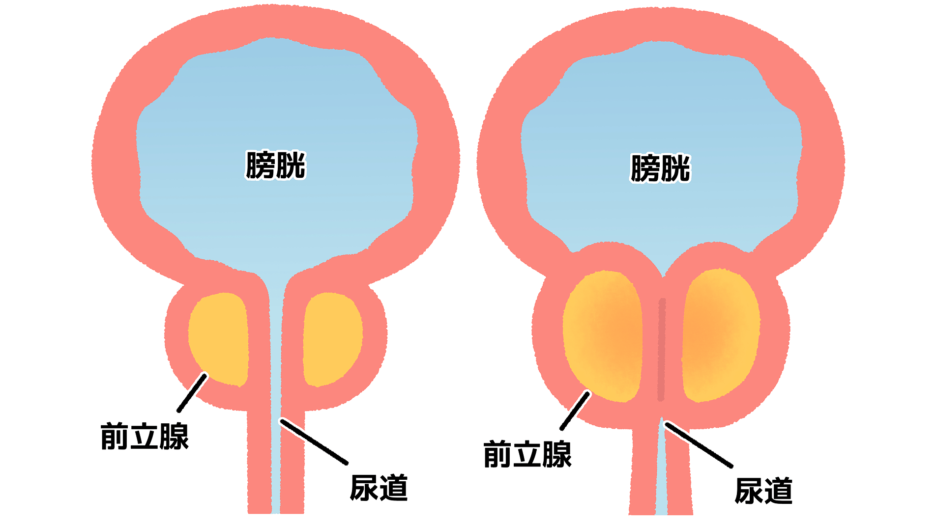尿の勢いの低下や夜間頻尿は受診のサイン――我慢せずまずは受診を