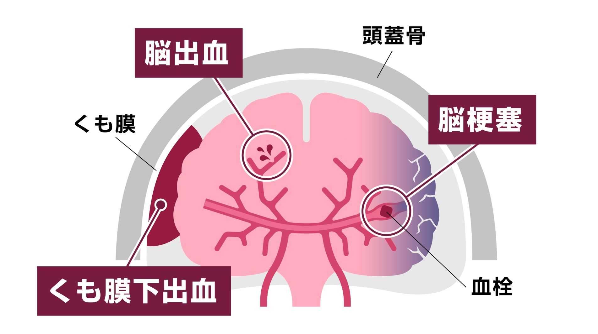 断らない医療をモットーに、脳卒中に即応できる体制を構築