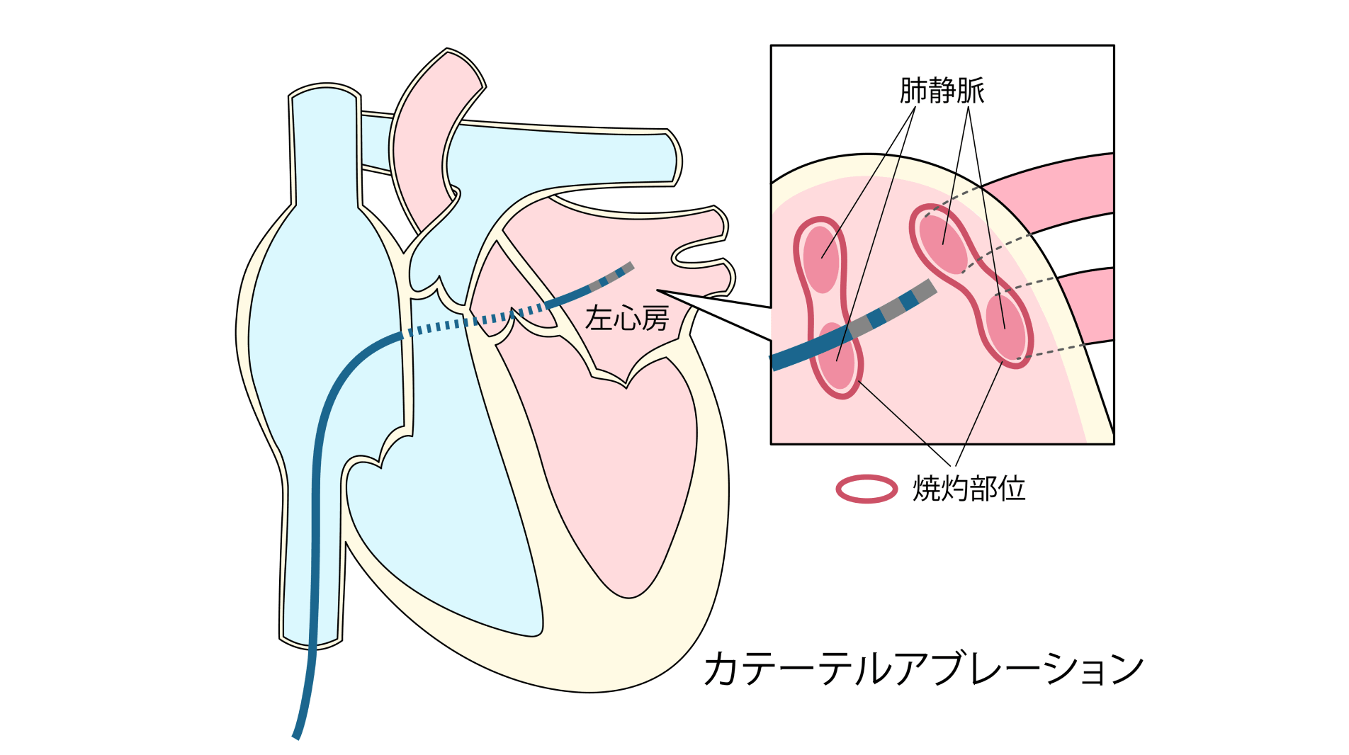 根治的な治療“カテーテルアブレーション”を実施可能な体制を整備