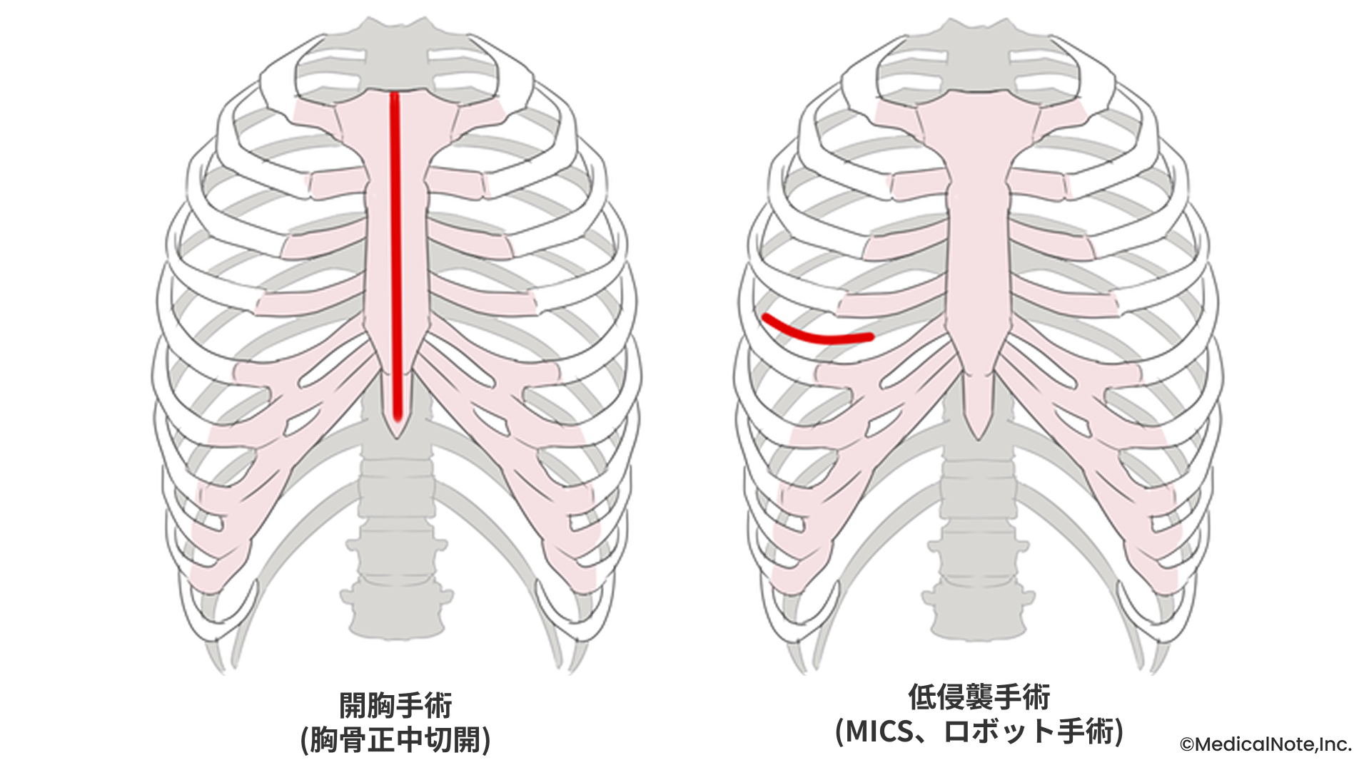 ロボット心臓手術とは――心臓弁膜症の新たな治療選択肢