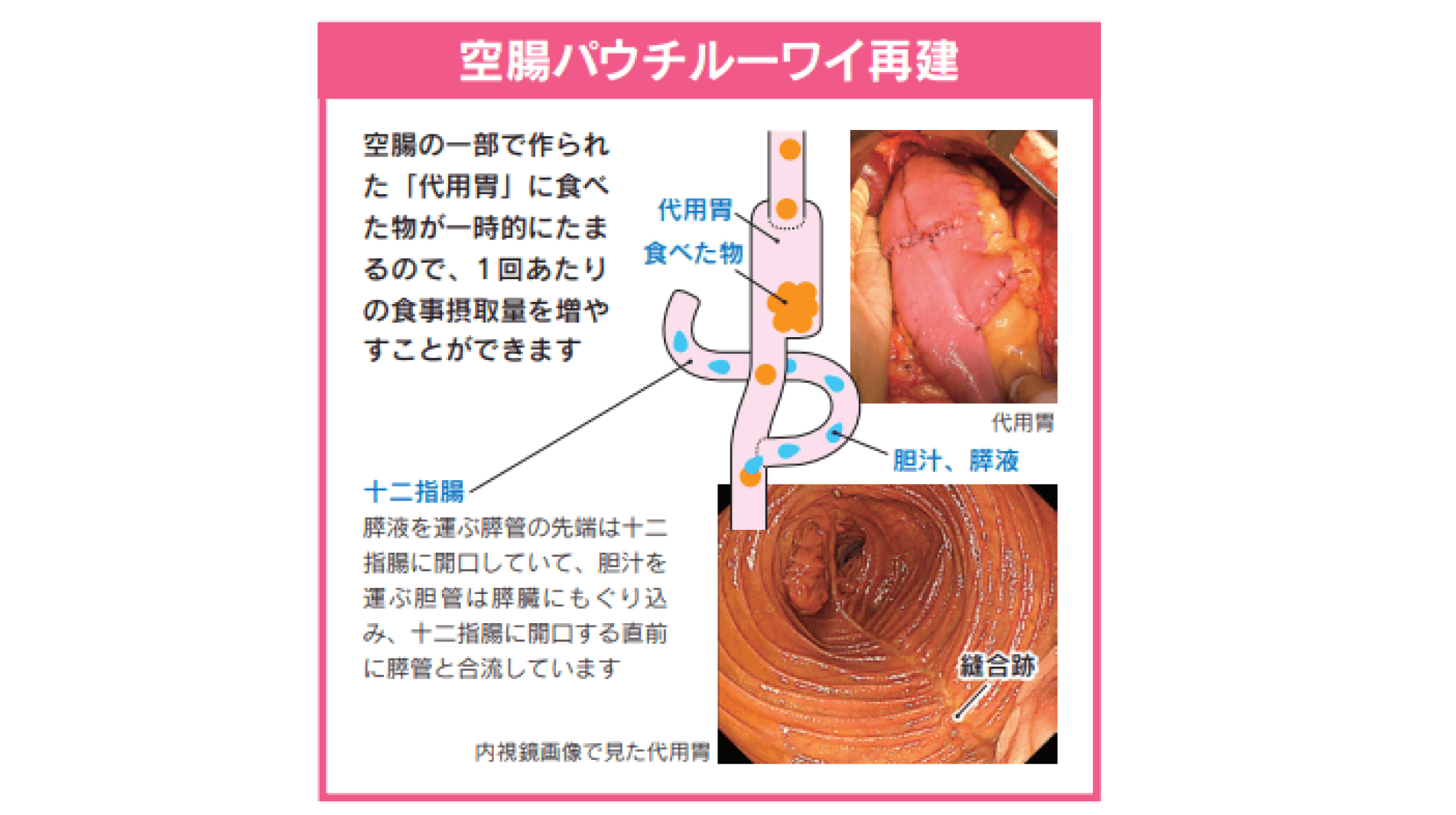 腹腔鏡や手術支援ロボットにより負担の少ない手術を提供――空腸パウチ再建も実施