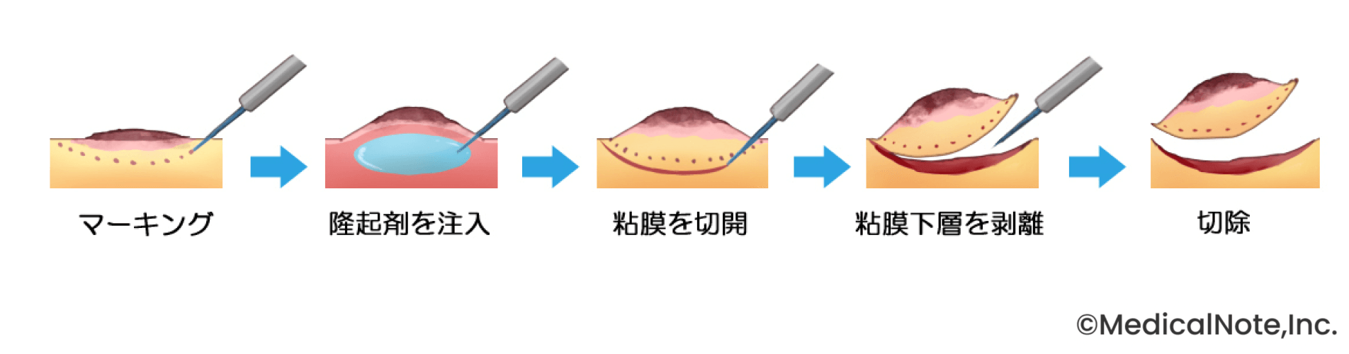 内科と外科が密に連携し内視鏡治療と手術の適応を見極める