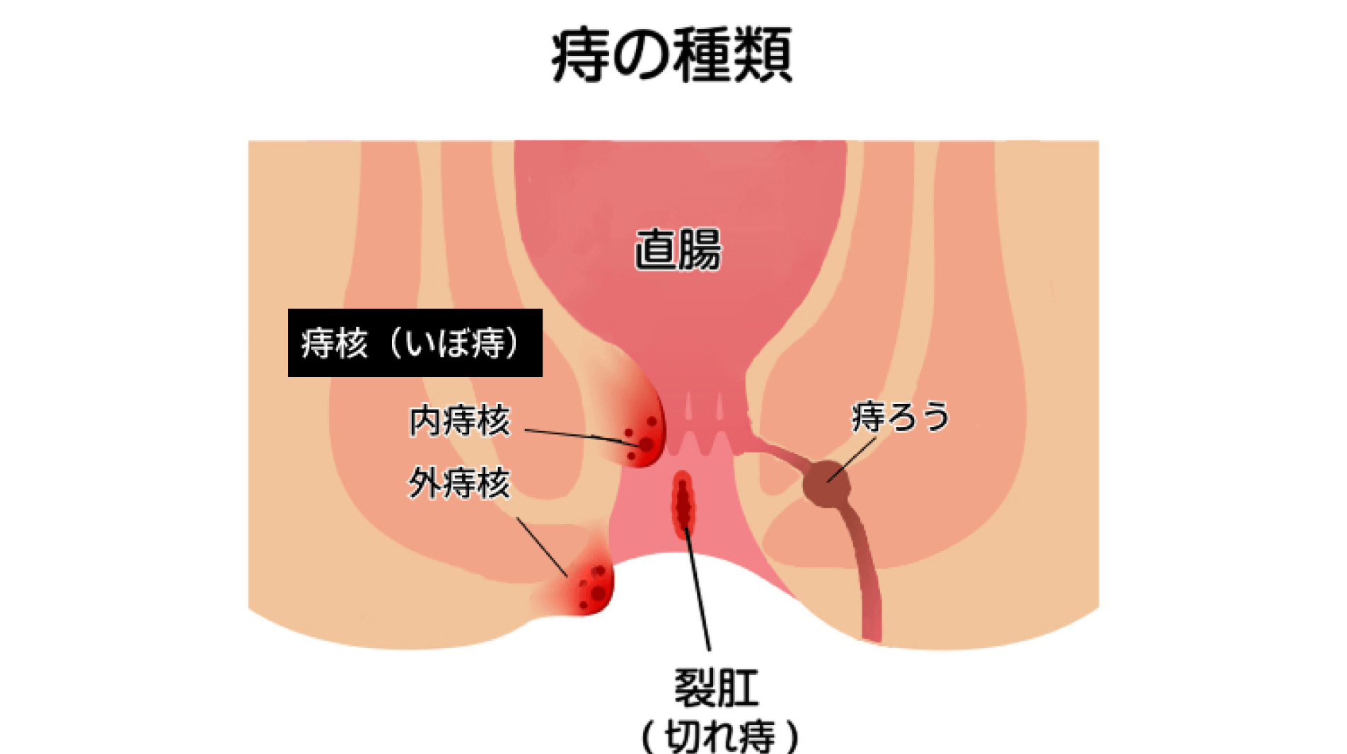 3人に1人といわれるほど一般的な病気――女性医師が診察する専門外来も設置