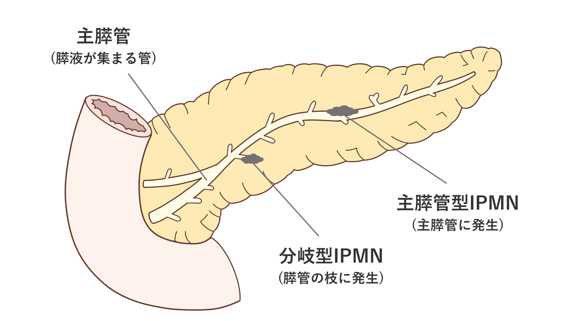 症状が出にくい膵臓の病気――がんになる前から見守る体制を築く