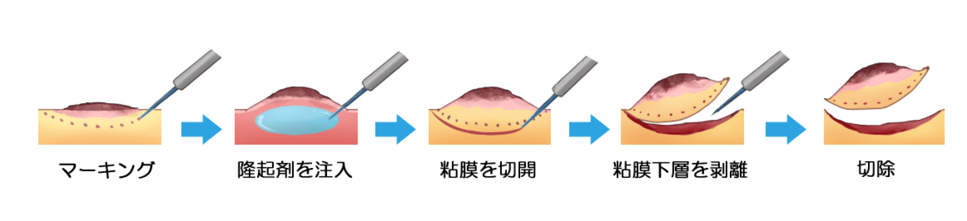 年間1,内視鏡的粘膜下層剥離術（ESD）の登場でより低侵襲な治療が可能に