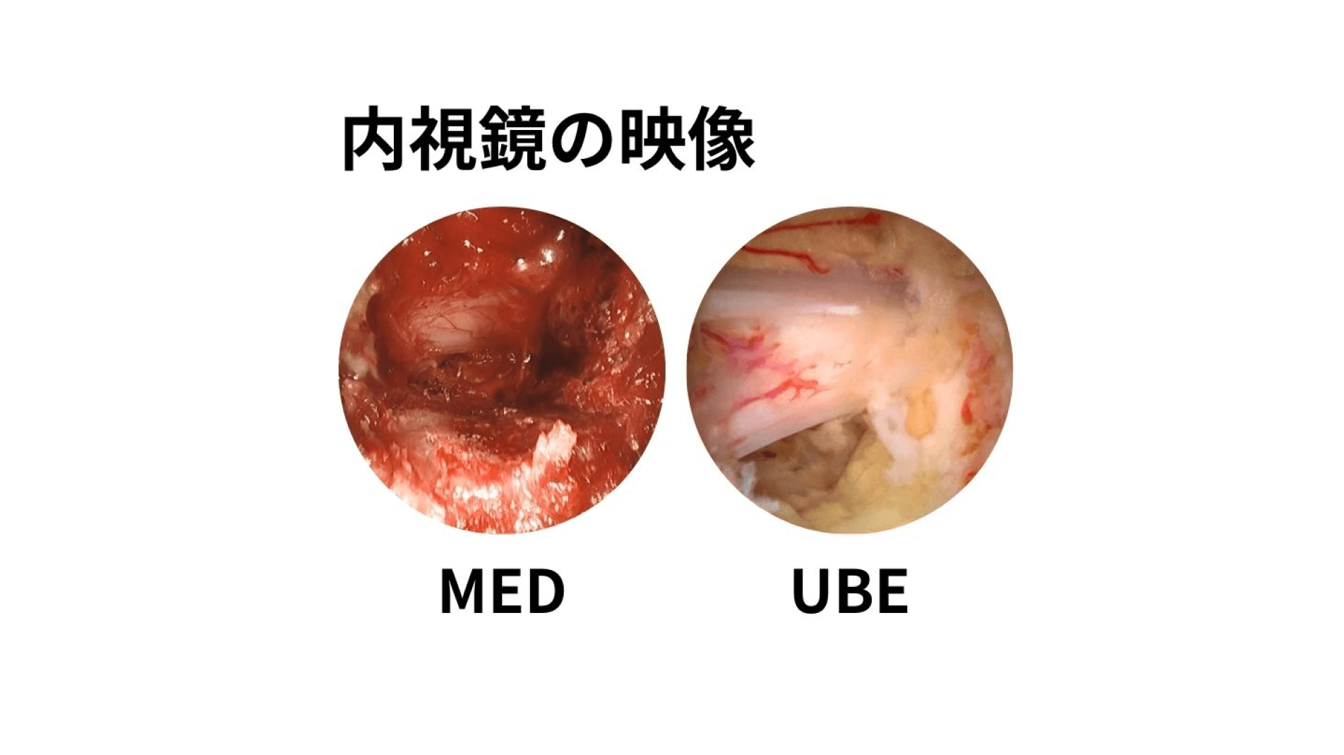 腰椎疾患に対する新たな低侵襲手術：UBE