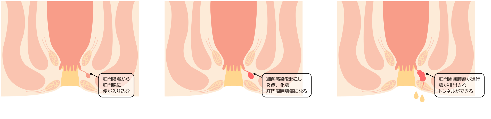 腸内からの感染が原因となる病気
