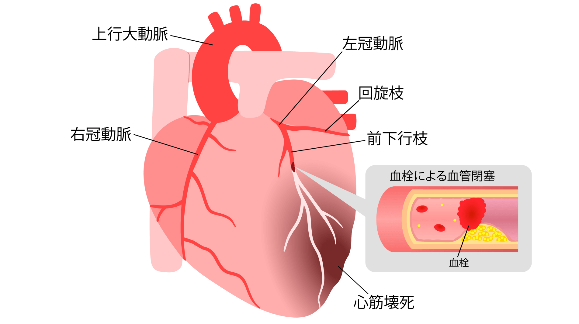 胸の重苦しさや圧迫感は放っておかずに一度受診を