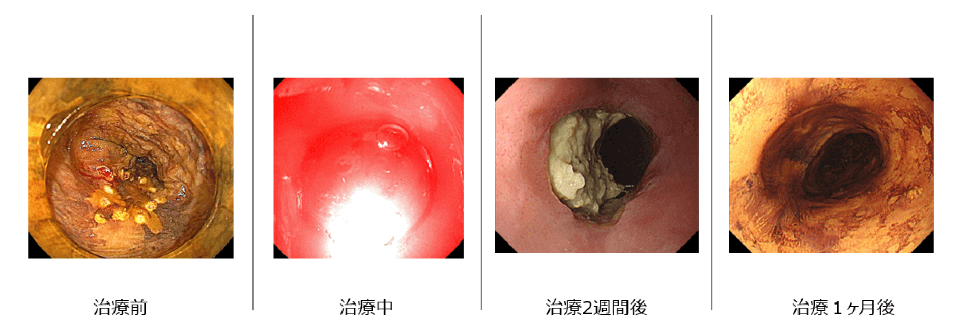 食道がんに対する光線力学的療法（PDT）を提供