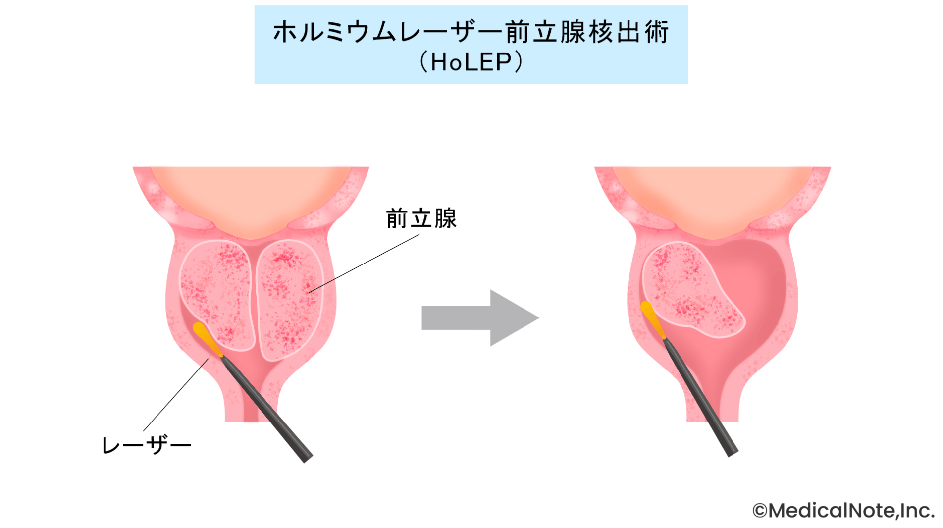 根本的かつ体への負担を抑えるレーザー治療「HoLEP」