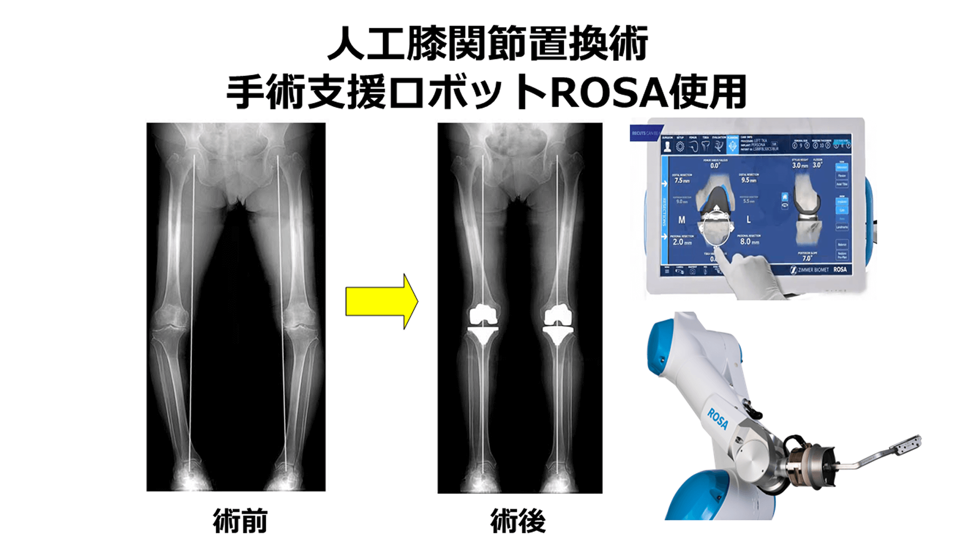 正確性を高めた人工関節手術をロボットで実現――関節を温存する手術にも対応